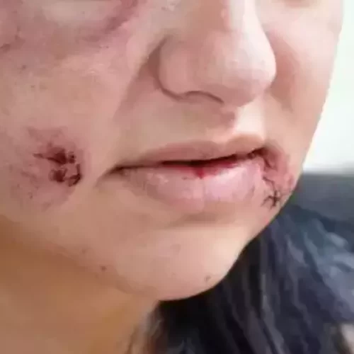 AGORA É LEI: SUS OFERECERÁ RECONSTRUÇÃO FACIAL E DENTÁRIA GRATUITA PARA MULHERES VÍTIMAS DE VIOLÊNCIA